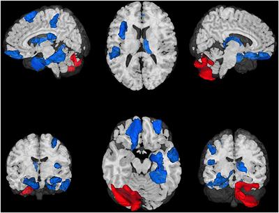 Daily Morning Blue Light Therapy for Post-mTBI Sleep Disruption: Effects on Brain Structure and Function